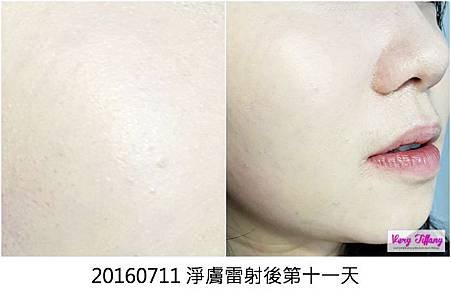 0711術後十天.jpg