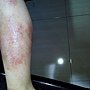 2013.9.15傷口狀況