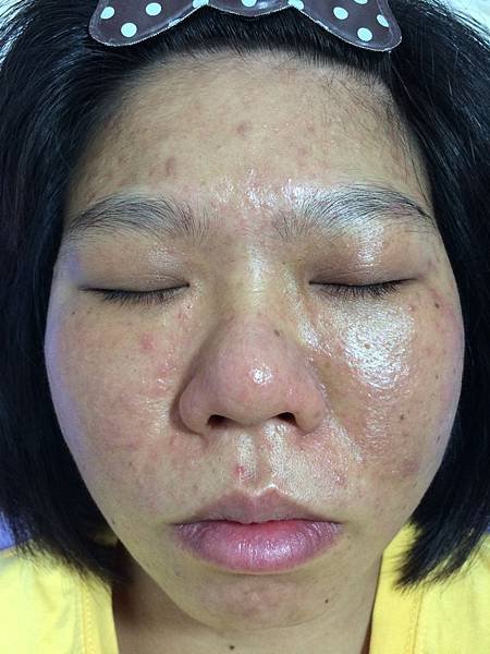 【痘痘粉刺成功之十九】莉莉小姐痘痘粉刺＋反黑  走了許多冤枉