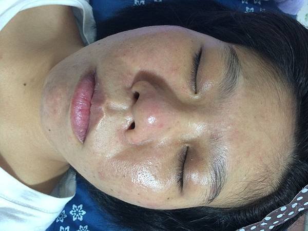 【痘痘粉刺成功之十九】莉莉小姐痘痘粉刺＋反黑  走了許多冤枉