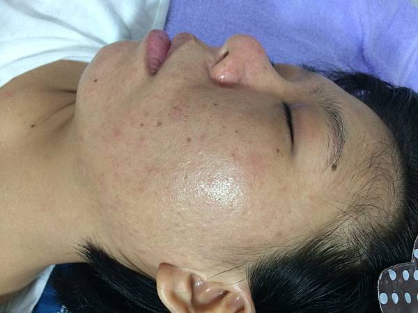 【痘痘粉刺成功之十九】莉莉小姐痘痘粉刺＋反黑  走了許多冤枉