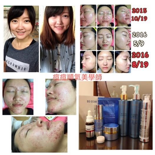 【痘痘粉刺成功之思羽正妹】十年多來，沒有一樣可以真正有效的阻