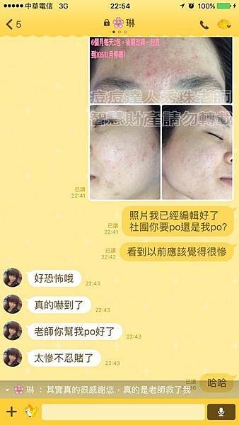 【痘痘粉刺成功之琳琳正妹】從小五長第一顆痘痘開始，我就擺脫不