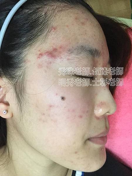 【痘痘粉刺成功之喬喬正妹】美女日夜顛倒所以痘痘就暴長