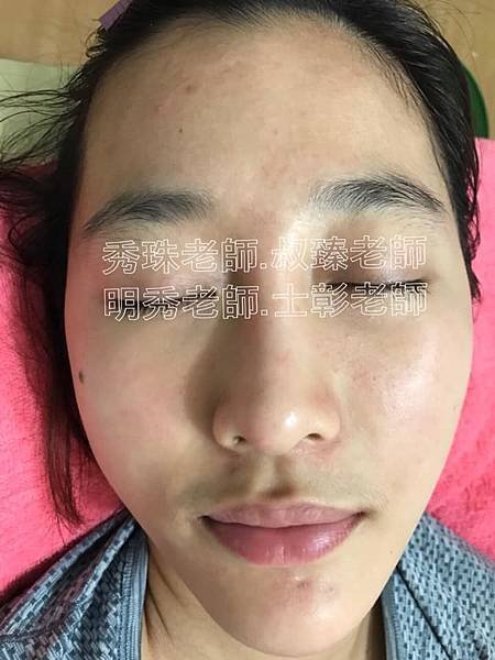 【痘痘粉刺成功之喬喬正妹】美女日夜顛倒所以痘痘就暴長