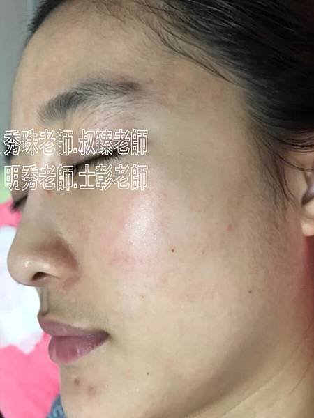 【痘痘粉刺成功之喬喬正妹】美女日夜顛倒所以痘痘就暴長
