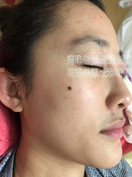 【痘痘粉刺成功之喬喬正妹】美女日夜顛倒所以痘痘就暴長