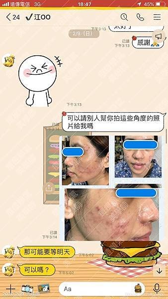 【痘痘粉刺成功之江江正妹】 臉變美就超開心，每天心情都很好