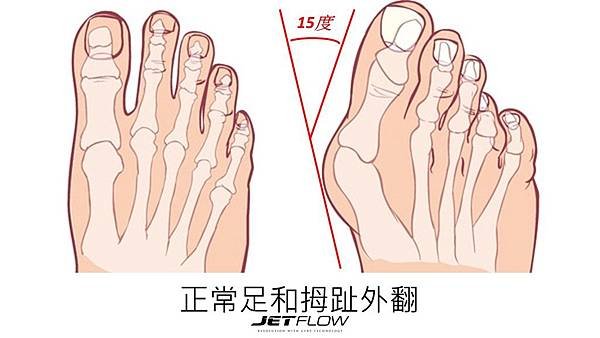 Hallux Valgus B.jpg