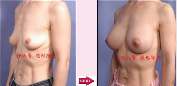 乳房提拉手術案例