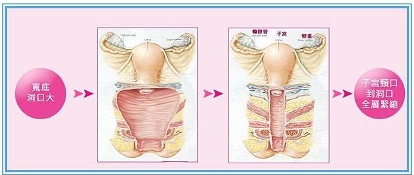 陰道鬆弛類型02