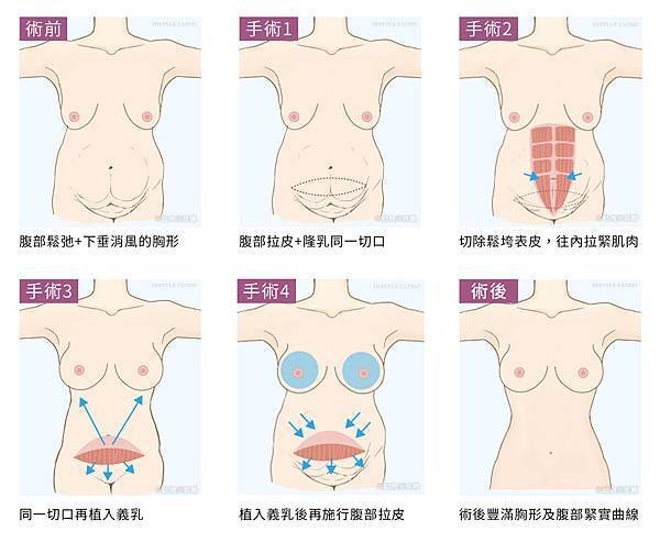 蘋果-TABA手術流程.jpg