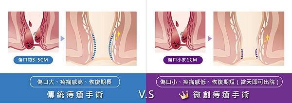 痔瘡手術比較圖-20190606.jpg