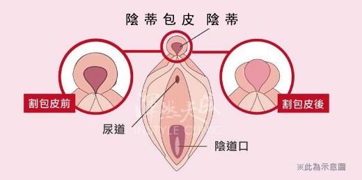 陰蒂包皮.JPG