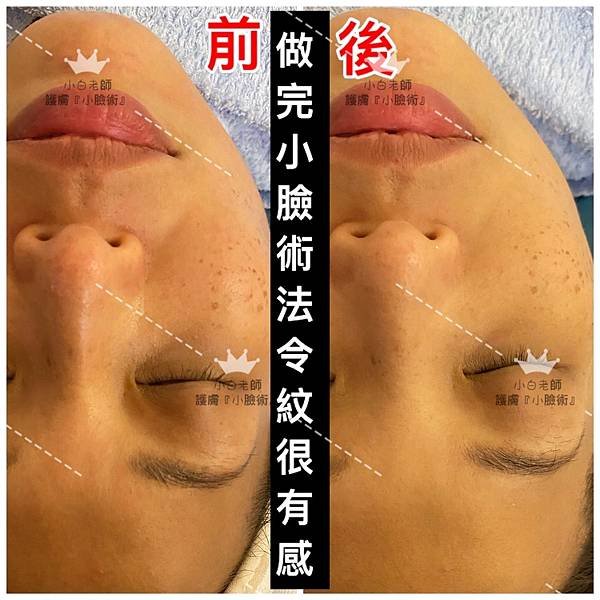 高雄左營。拯救鬆垮媽媽臉 小V臉拉提魔雕手 │ 高雄小白老師