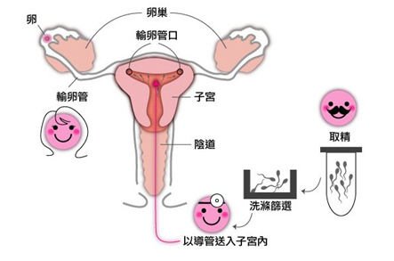 [七七猴求子路-上篇] 李茂盛諮詢+美村婦產科人工授孕，原來