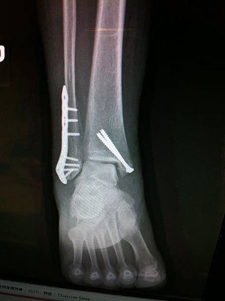 fibula fracture