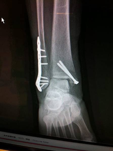 fibula fracture 2