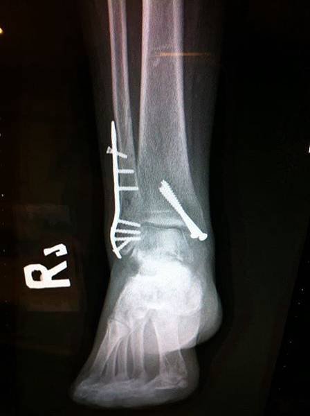 fibula fracture 3