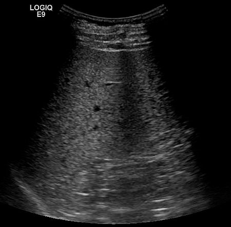 29535113 METASTATIC LIVER TUMOR-EARLY 拷貝