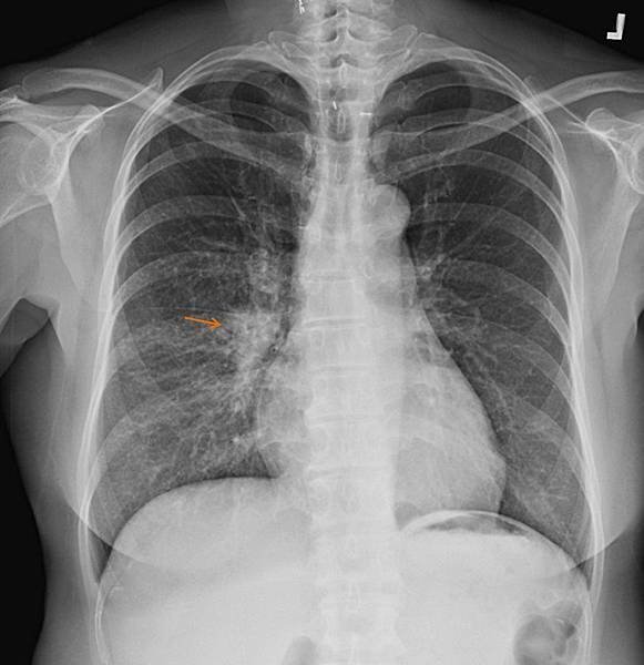 Lung cancer coung 1-2