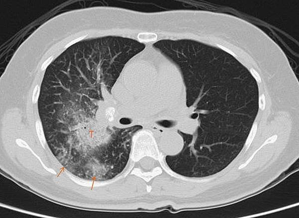 Lung cancer coung 2-2