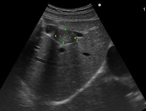 HEPATOMA 28099221A 拷貝