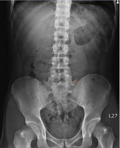 ureteral stone1