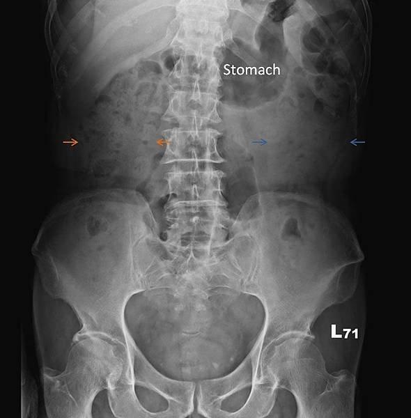 Pleural effusion 5