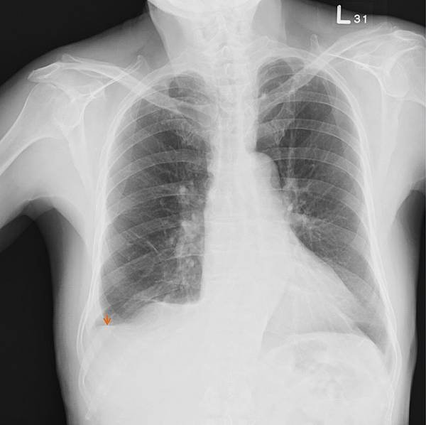 15330548 pleural effusion