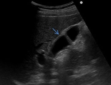 Pleural effusion 3