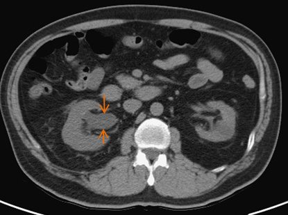 20884791 CT RENAL STONE