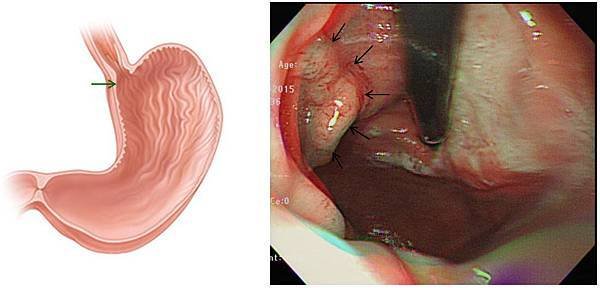 Gastric cancer