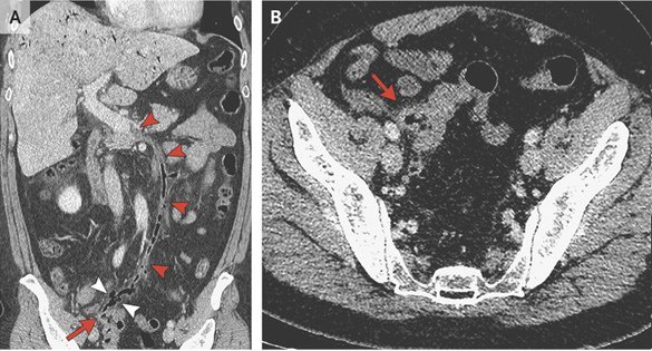 SIGMOID COLON DIVERTICULITIS