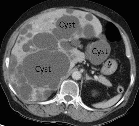 CT-cyst