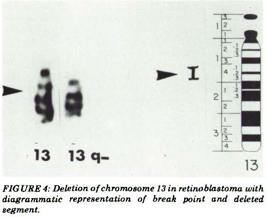 Retinoblastoma chromosome 13 del