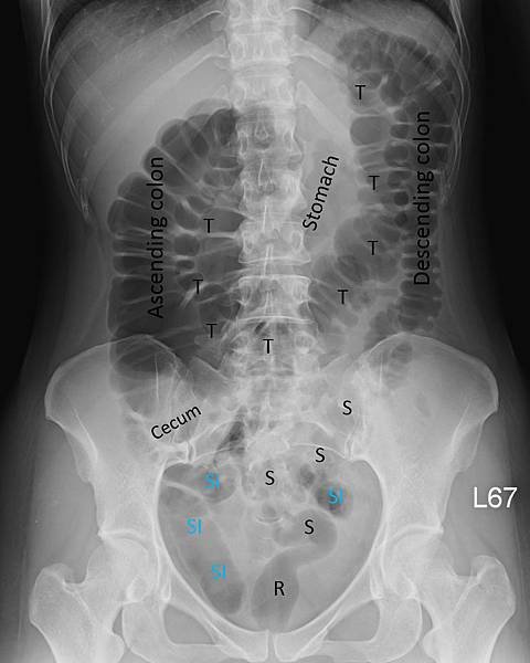 KUB after colonoscopy