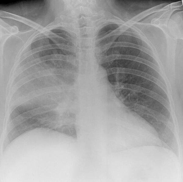 pneumococcal pneumonia-cxr