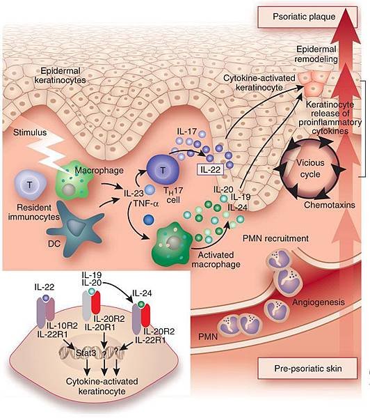 Psoriasis and Th17