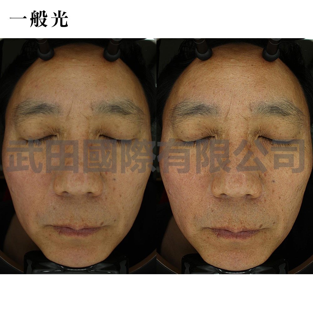 Mark-vu皮膚專業檢測儀-4-mark一般光.jpg