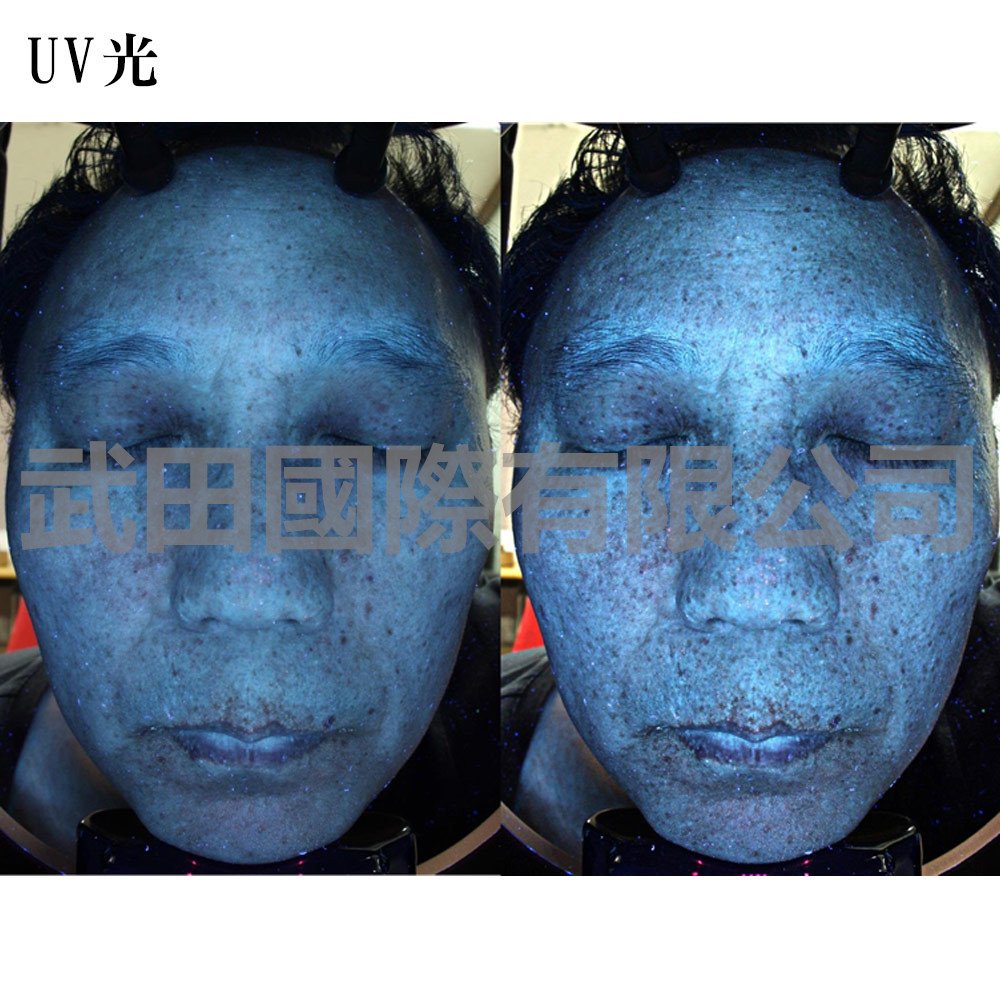 Mark-vu皮膚專業檢測儀-5-markUV光.jpg