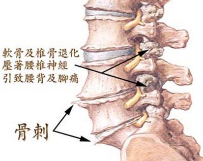 ã€Œéª¨åˆºã€çš„åœ–ç‰‡æœå°‹çµæžœ