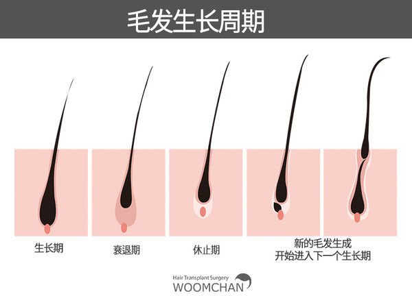 植髮後三個月內沒有掉髮? 是正常的嗎?