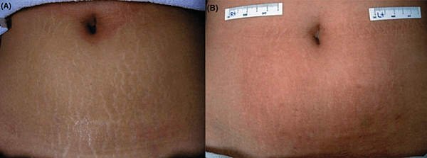 striae distensae case 1