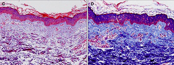 striae distensae patho