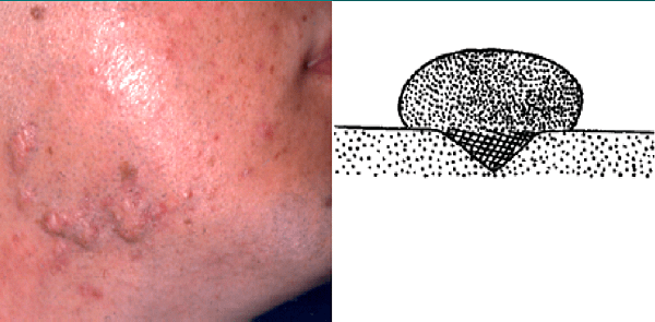 keloid acne scar