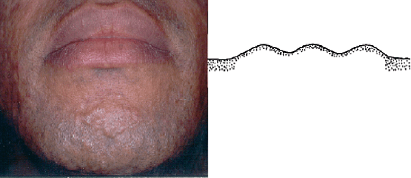 papular acne scar