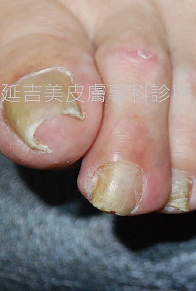 onychomycosis case-3