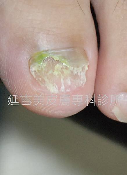 onychomycosis case-4a