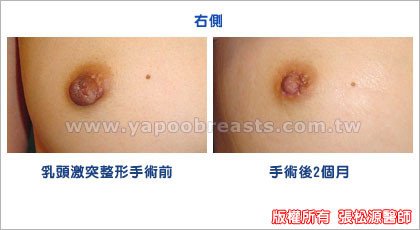 乳頭整形手術案例5.jpg